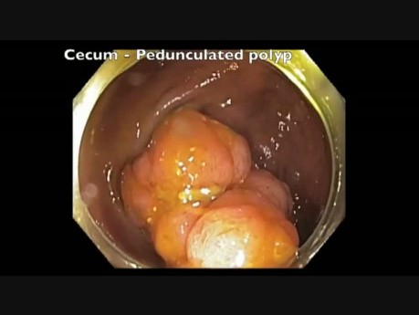 Complicaciones de la resección mucosa endoscópica (RME) - sangrado del ciego - video A