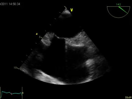 Hipertrofia Lipomatosa del Tabique Atrial (HLTA) - Video nr 2