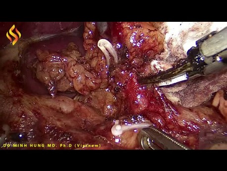 Disección laparoscópica de ganglios linfáticos del área suprapancreática para cáncer gástrico