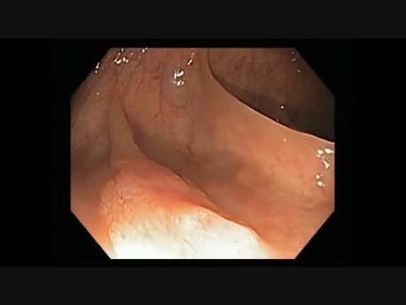 Canal de colonoscopia - adenoma serrado con cáncer intramuscular