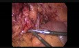 Sigmoidectomía laparoscópica para fístula colovaginal complicada por diverticulitis