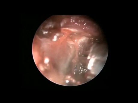Extirpación endoscópica de hemangioma cavernoso de fosa infratemporal mediante antrostomía del meato inferior