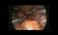 Corte de sonda gástrica laparoscópica