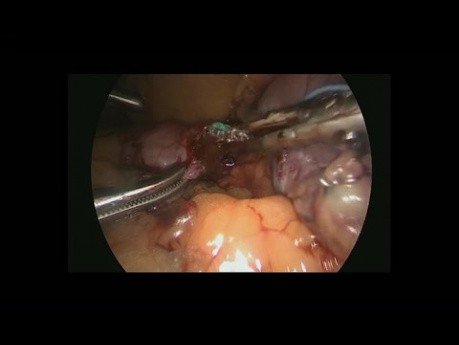 Corte de sonda gástrica laparoscópica