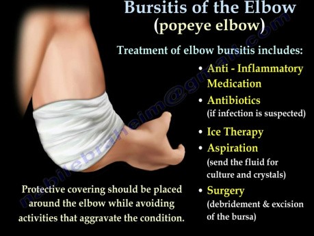 Bursitis del codo - video-clase