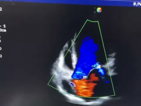 13. Caso de ecocardiografía - ¿Qué se ve?