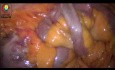 Buscando diverticulitis de Meckel