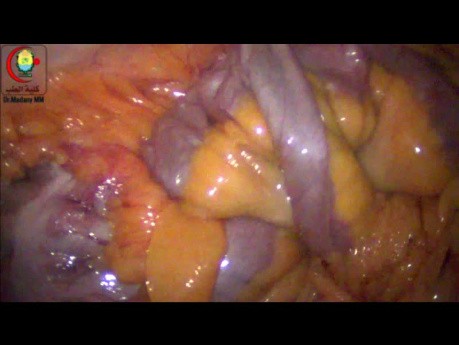 Buscando diverticulitis de Meckel