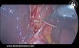 Anatomía del surco de Rouvière observada durante la colecistectomía laparoscópica