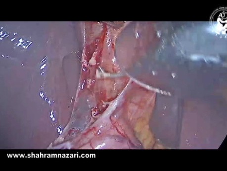 Anatomía del surco de Rouvière observada durante la colecistectomía laparoscópica