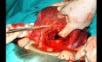 Técnica de sutura B-Lynch para hemorragia posparto