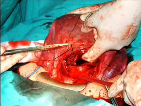 Técnica de sutura B-Lynch para hemorragia posparto