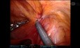 Reparación robótica R TAPP de hernia crural femenina encarcelada