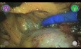 Nefrectomía Parcial Retroperitoneal con Versius - Muddassar Hussain
