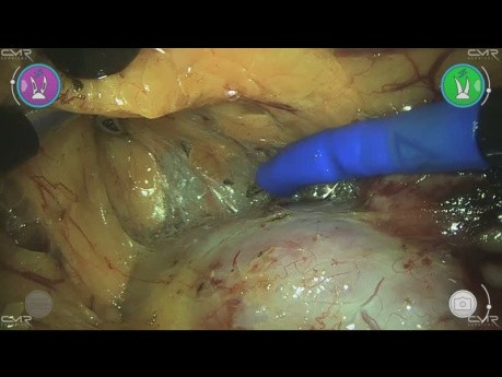 Nefrectomía Parcial Retroperitoneal con Versius - Muddassar Hussain