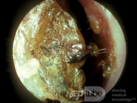 Úlcera y costras del tabique nasal