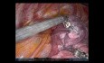 Tri-segmentectomía pulmonar del lóbulo superior izquierdo S1-3