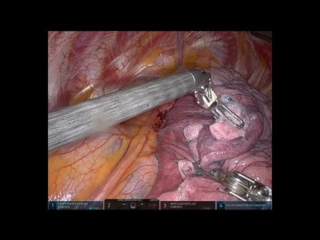 Tri-segmentectomía pulmonar del lóbulo superior izquierdo S1-3