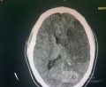 Craniectomía descompresiva en infarto maligno de la arteria cerebral media