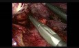 Esplenectomía laparoscópica asistida con la mano con resección multiorgánica 