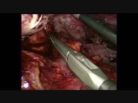 Esplenectomía laparoscópica asistida con la mano con resección multiorgánica 
