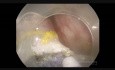 DSE de pólipo sigmoideo pediculado grande - cómo afrontar los grandes vasos en el tallo.