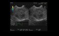 Ecografía endoscópica del tumor pseudopapilar pancreático