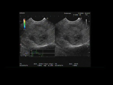 Ecografía endoscópica del tumor pseudopapilar pancreático