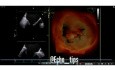 ECG - Prolapso de la válvula mitral con cuerdas rotas y análisis "Speckle Tracking" de la función ventricular izquierda