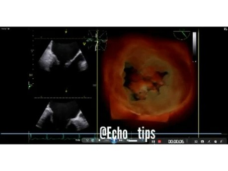 ECG - Prolapso de la válvula mitral con cuerdas rotas y análisis "Speckle Tracking" de la función ventricular izquierda