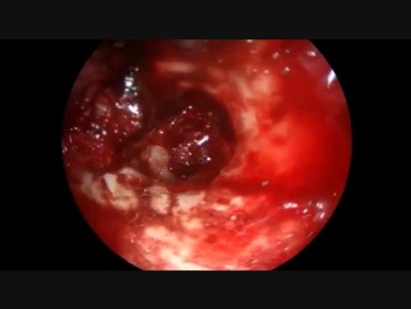 Glomus timpánico - Abordaje endoscópico transcanal